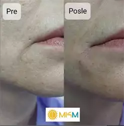 Korekcija finih bora i modeliranje ugla usana pomoću filera.