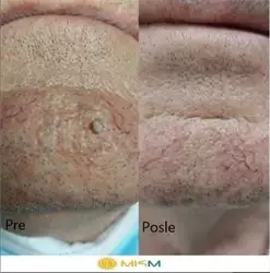 Uklanjanje benigne promene na koži kao što su viseće bradavice