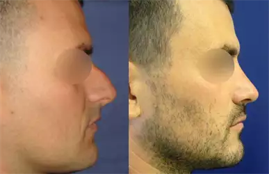 Poliklinika Novaković korekcija nosa