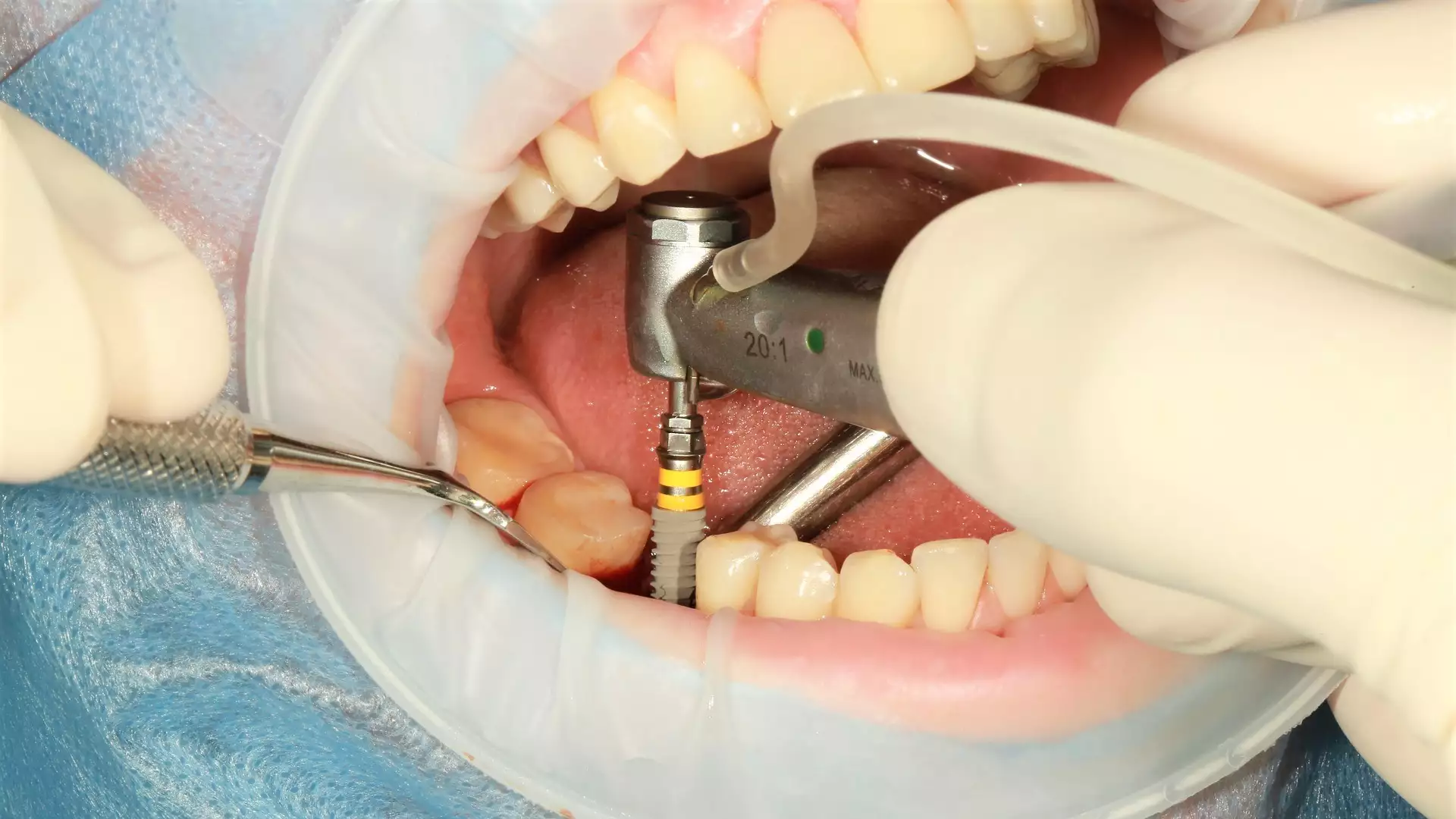 slika kategorije Zubni implanti i protetika